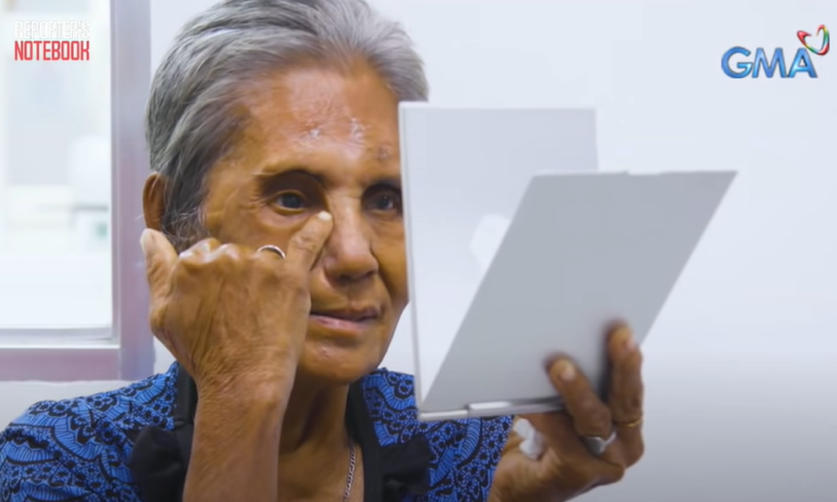 Facial Prosthesis