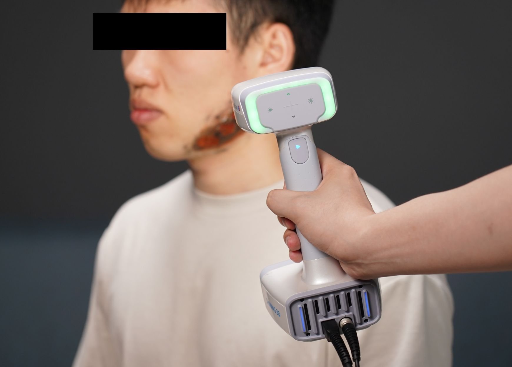 3d scanning for wound care and burn treatment new