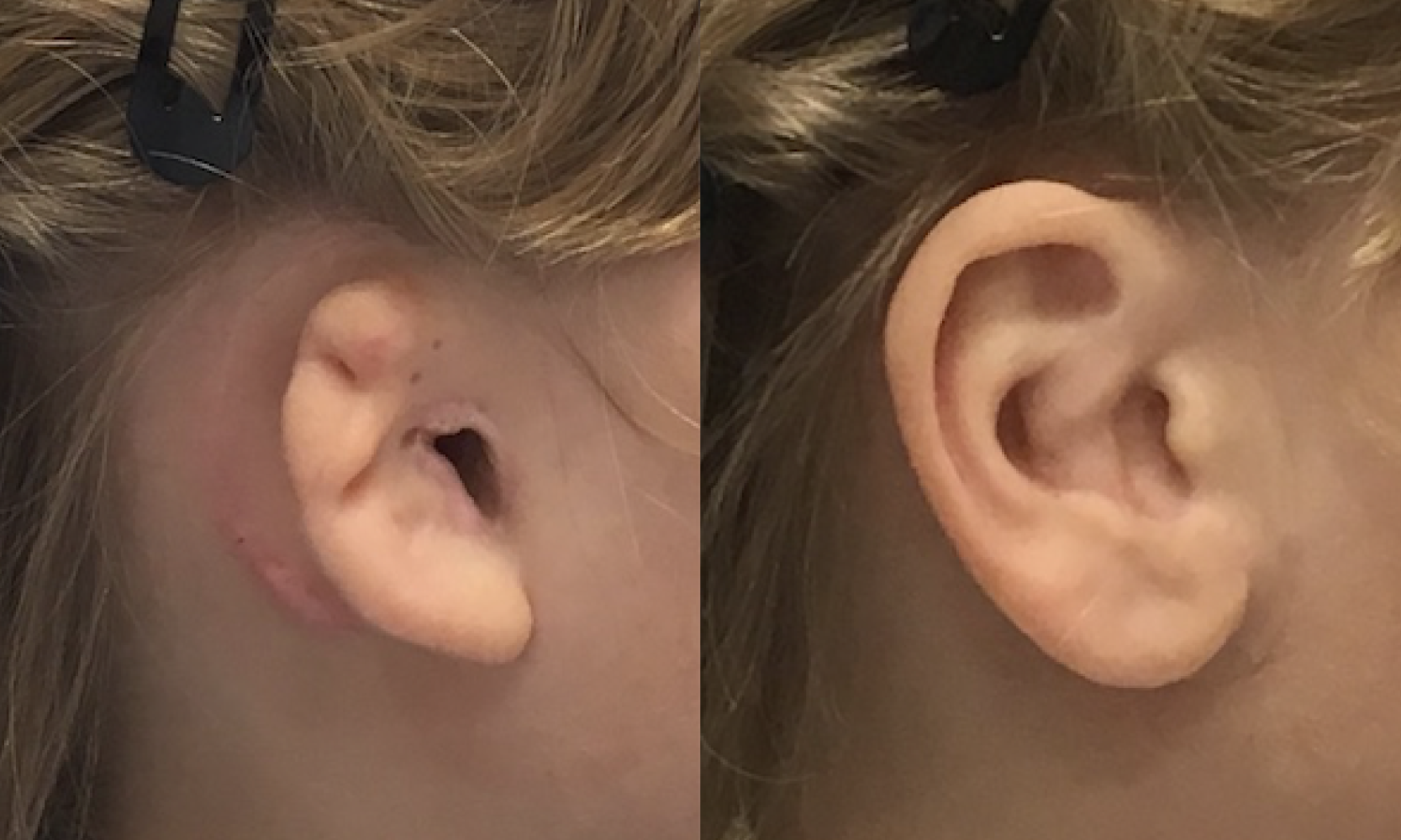 Ear Prosthesis
