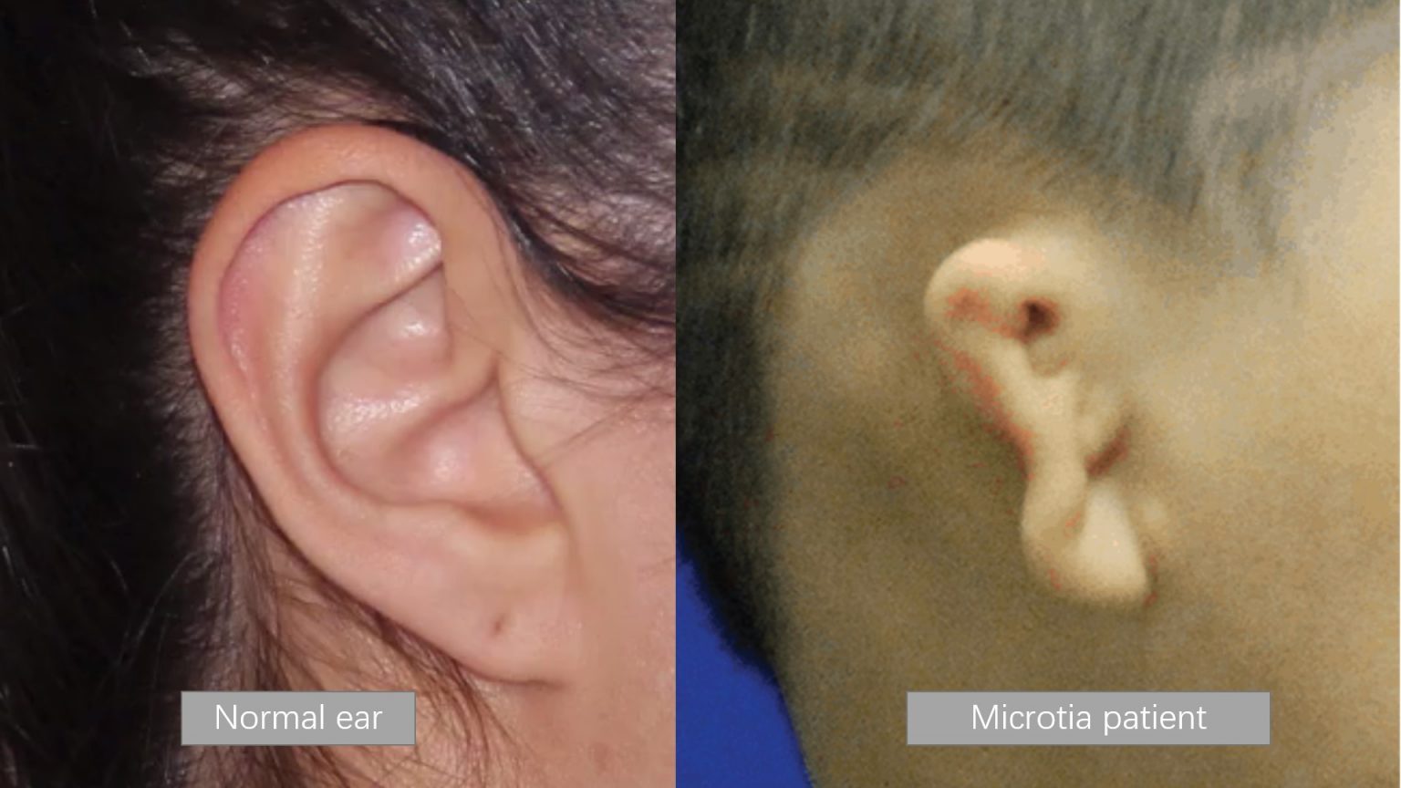 Comparison of normal ear and microtia patient