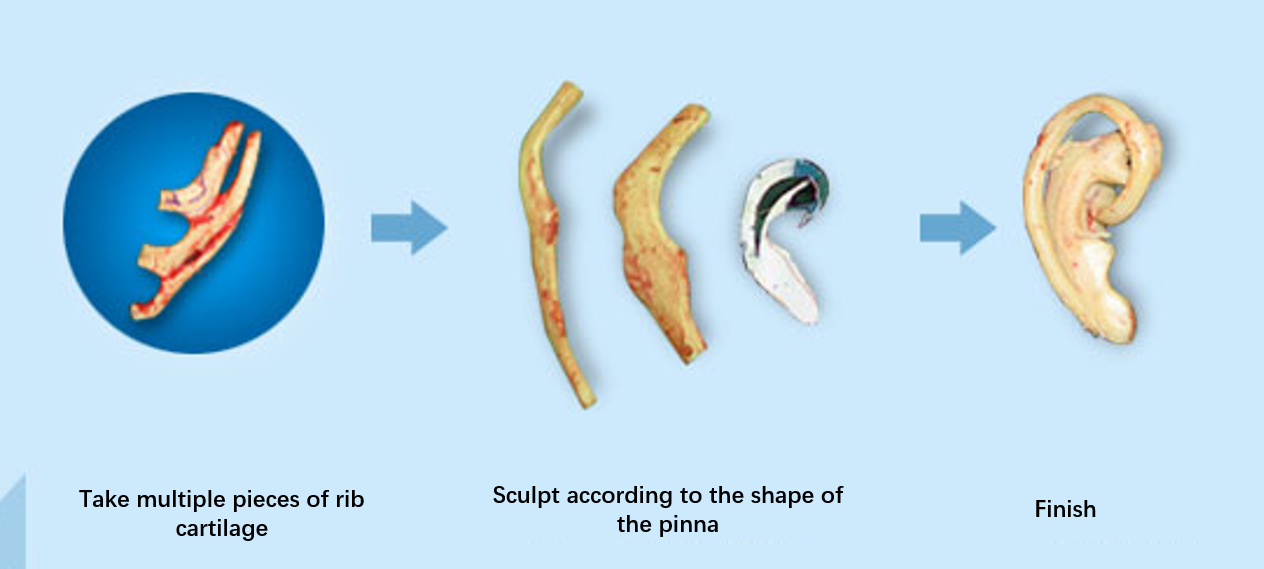 Traditional treatment methods for microtia 