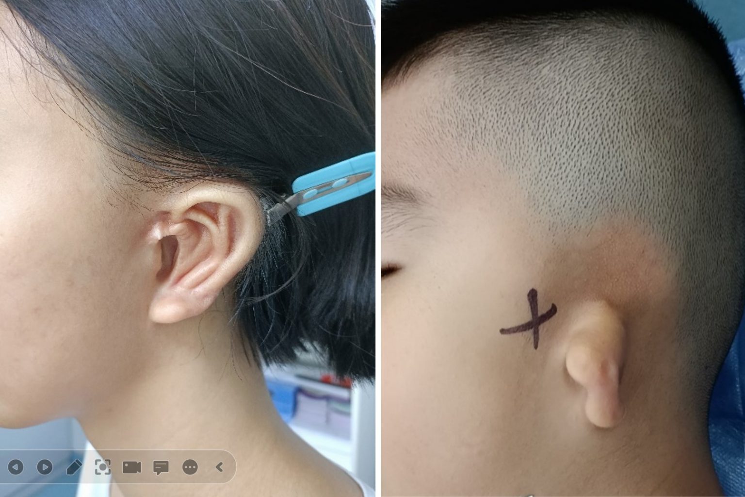 Different types of microtia Different types of microtia