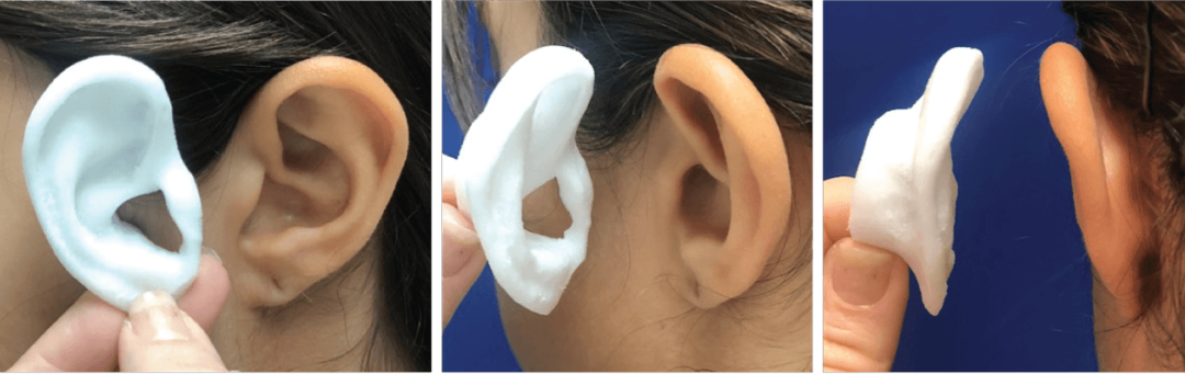 3D printed template of the reconstructed ear 3D printed template of the reconstructed ear
